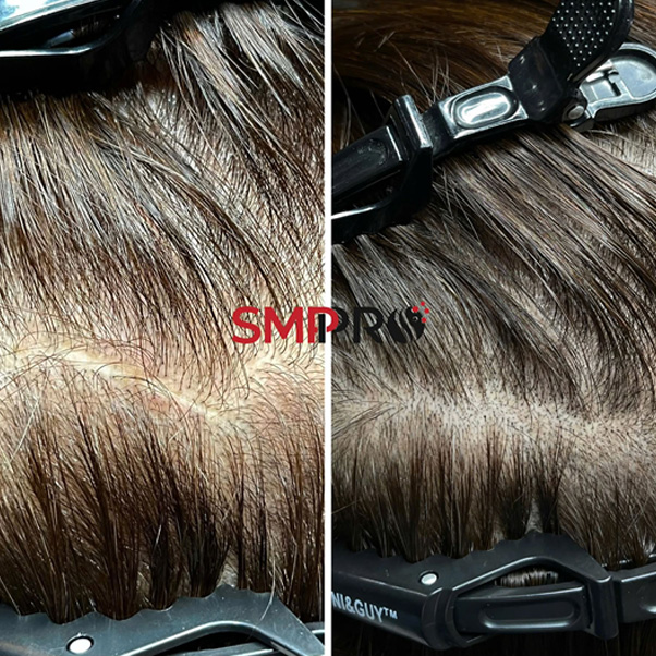 scalp_8